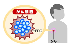 FGTを取り込んだがん細胞の説明図