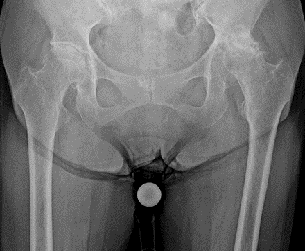 左変形性股関節症に対する人工股関節置換術施行例（手術前）