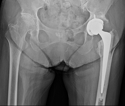 左変形性股関節症に対する人工股関節置換術施行例（手術後）
